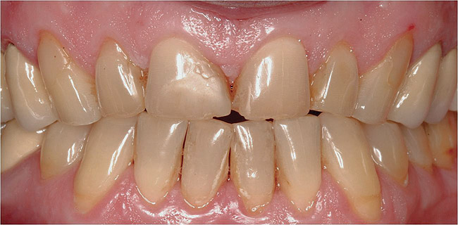 Grau sich zahn verfärbt Zahnverfärbungen: Das