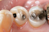 Figure  2  Loss of tooth surface surrounding amalgam and appearance of the restoration protruding from the tooth surface.