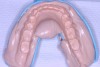 Figure 3  Occlusal view of AlgiNot impression of existing lower denture to be poured up in stone.