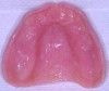 Figure 4  Using the existing upper denture as a custom tray for final impression.