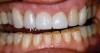 Figure  7  Porcelain-fused-to-metal restorations opposing the natural teeth.