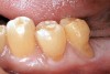 Figure  8  Loss of posterior teeth and altered occlusal load and resultant V-shaped tooth surface loss.