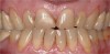 Figure  13   This patient was unhappy with the unesthetic appearance due to tooth surface loss.