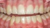 Figure 4  White spot lesions are imperceptible, blending with natural tooth color, after caries infiltration therapy (photograph courtesy of S. Paris and H. Meyer-Lueckel).